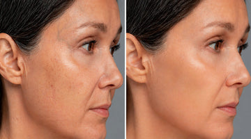 CO2 Laser Treatment at Giffen Health Med Spa Los Angeles