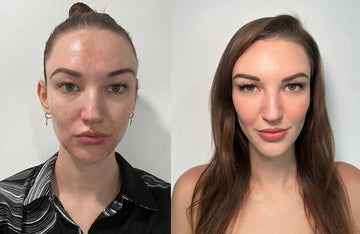 CO2 Laser Acne Scar Removal in Los Angeles: A Simple Guide to Smoother Skin